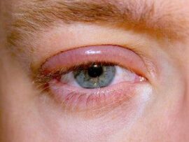 Blepharitis