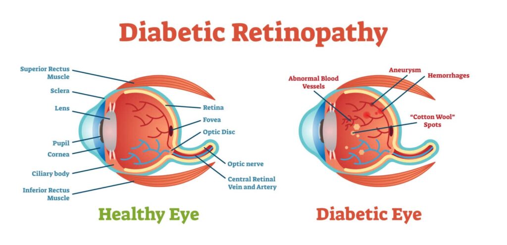 Diagram of healthy eye and diabetic eye