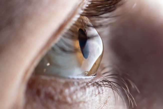 Close up of eye with keratoconus